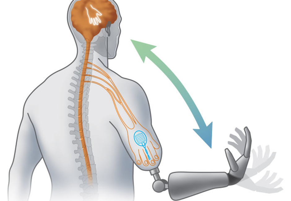 L'arto bionico in tre step di Natural Bionics.